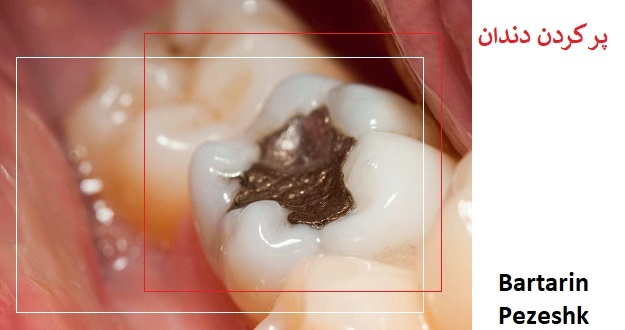 پر کردن دندان دندانپزشک در زعفرانیه