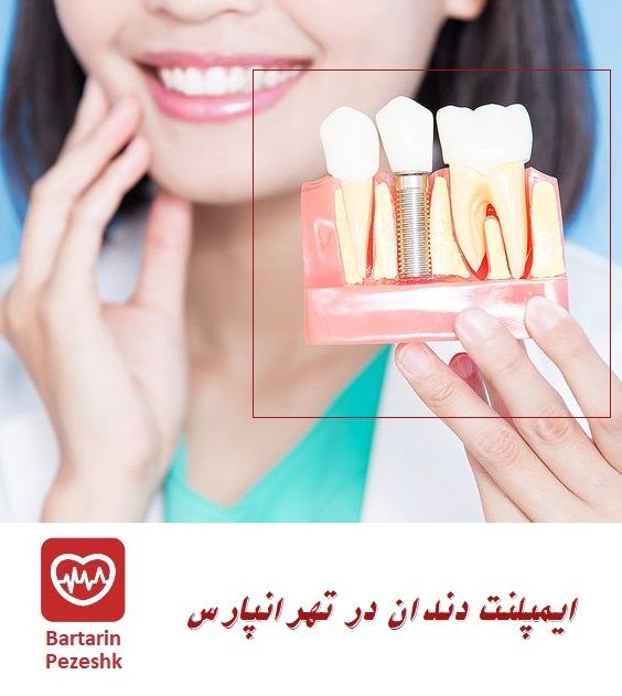 ایمپلنت دندان در تهرانپارس