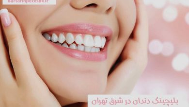 بلیچینگ دندان در شرق تهران