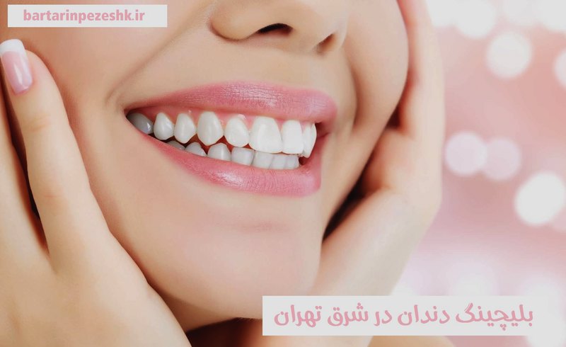 بلیچینگ دندان در شرق تهران