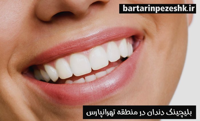بلیچینگ دندان در تهرانپارس