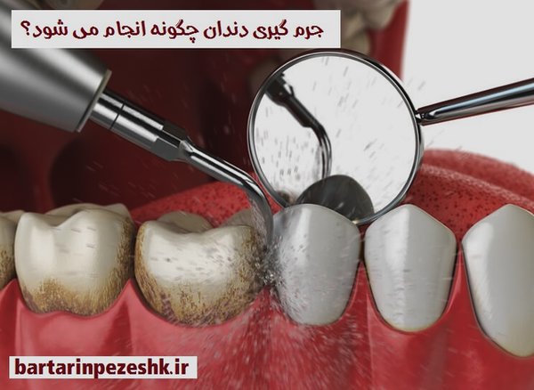 جرم گیری دندان در تهرانپارس