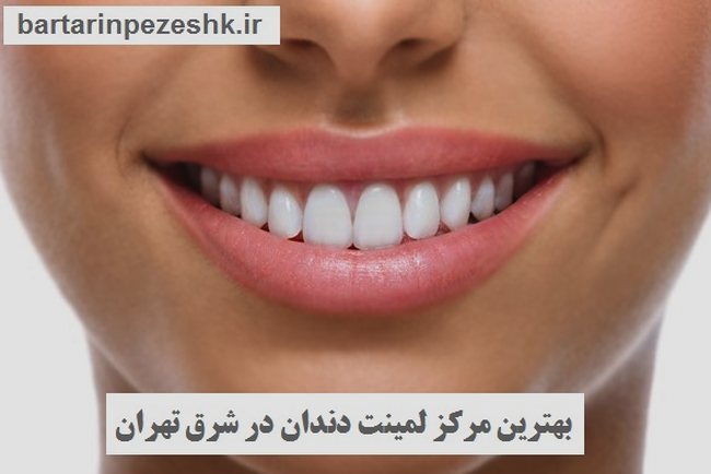 لمینت دندان در شرق تهران