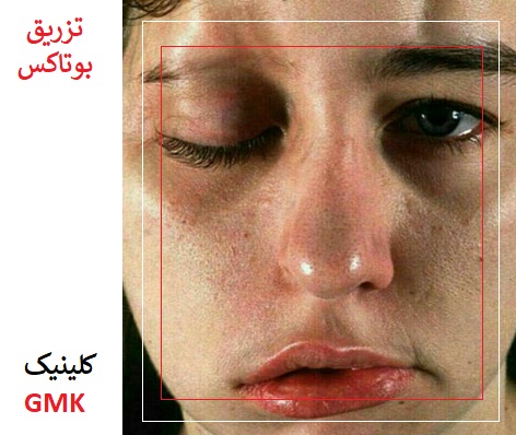 عوارض بوتاکس