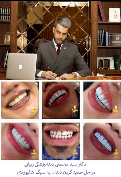 سفید کردن دندان ها در شرق تهران