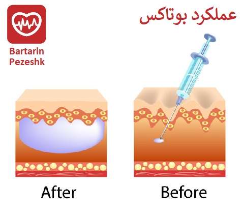 بوتاکس چگونه کار می کند؟