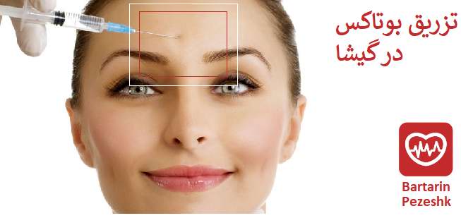 تزریق بوتاکس در گیشا