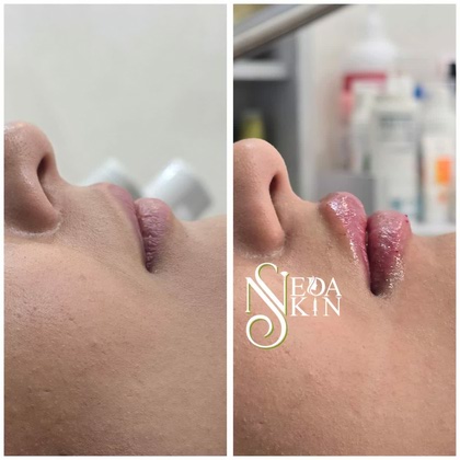 نمونه تزریق فیلر لب مرکز زیبایی ندا