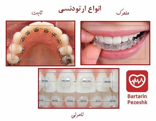 انواع ارتودنسی دندان : متحرک - ثابت - نامرئی