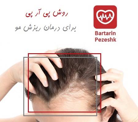 روش پی آر پی برای درمان ریزش مو