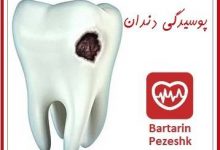 پوسیدگی دندان و عصب کشی دندان در غرب تهران