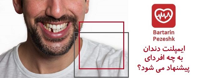 ایمپلنت دندان به چه افرادی پیشنهاد می شود؟