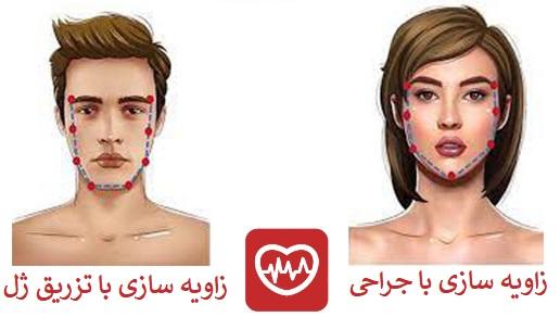 مزایای زاویه سازی با ژل نسبت به جراحی 