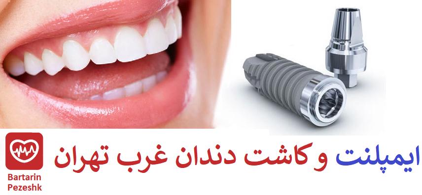 ایمپلنت و کاشت دندان در غرب تهران