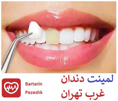 لمینت دندان غرب تهران
