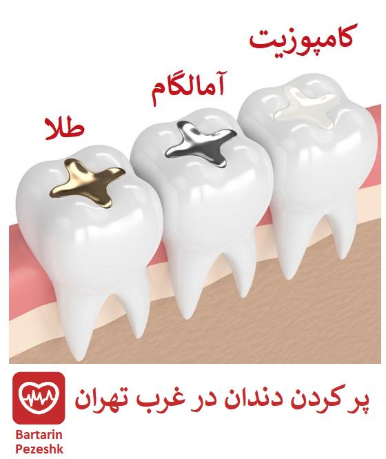 پر کردن دندان در غرب تهران