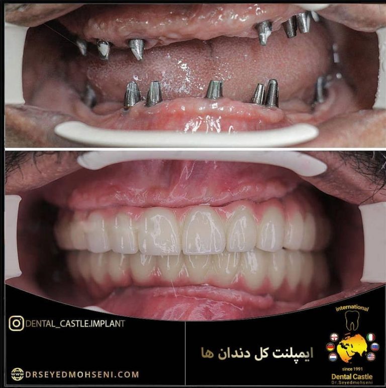 مرکز ایمپلنت دندان