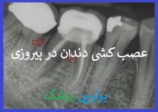 مرکز عصب کشی دندان در پیروزی