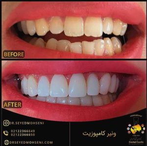 مطب دندانپزشکی دکتر سید محسنی ونیر کامپوزیت تهران