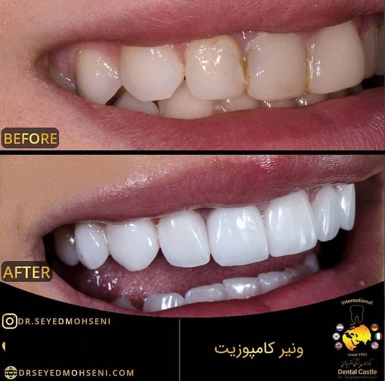 قبل و بعد از سفید کردن دندان به روش بلیچینگ