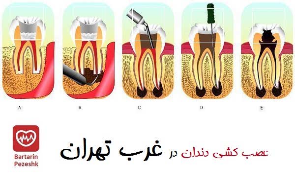 عصب کشی دندان در غرب تهران