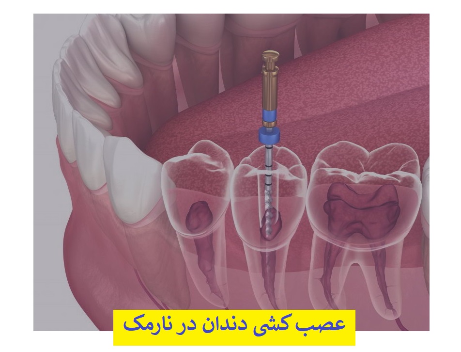 عصب کشی دندان در نارمک