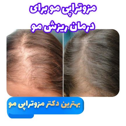 درمان ریزش مو با مزوتراپی در تهران