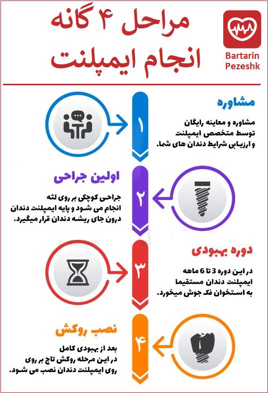 مراحل ایمپلنت در تهران