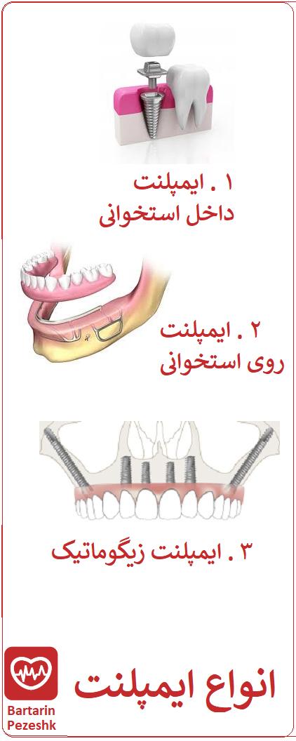 انواع ایمپلنت دندان کدامند؟