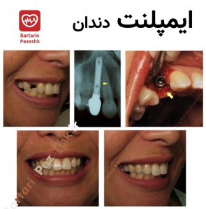 ایمپلنت دندان 6