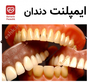ایمپلنت دندان 8