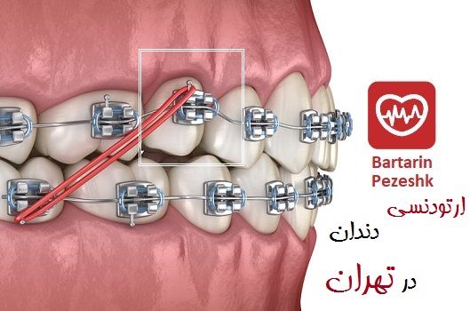 ارتودنسی دندان در تهران