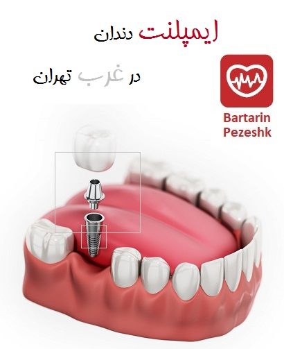 ایمپلنت دندان در غرب تهران