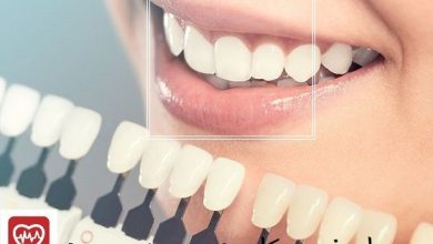 تفاوت لمینت و کامپوزیت دندان چیست؟