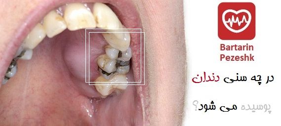 در چه سنی دندان پوسیده می شوند؟