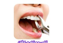 عصب کشی دندان منطقه 1 تهران