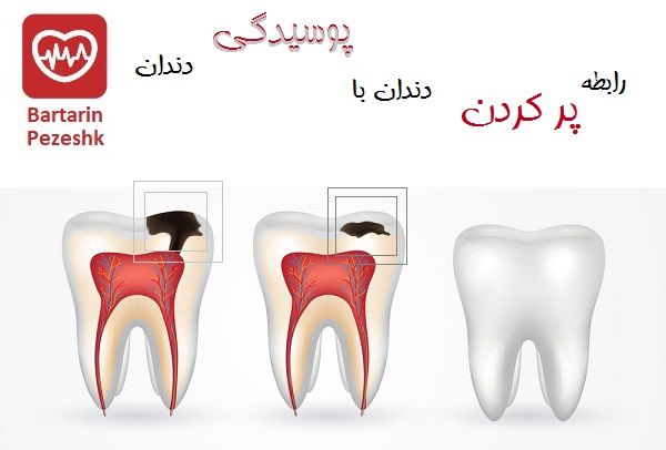 رابطه پر کردن دندان با پوسیدگی دندان