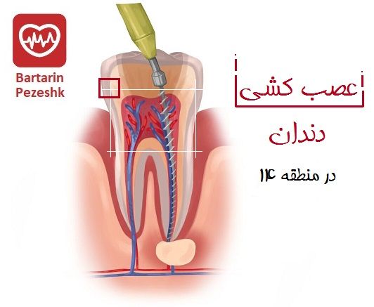 عصب کشی دندان در منطقه 14