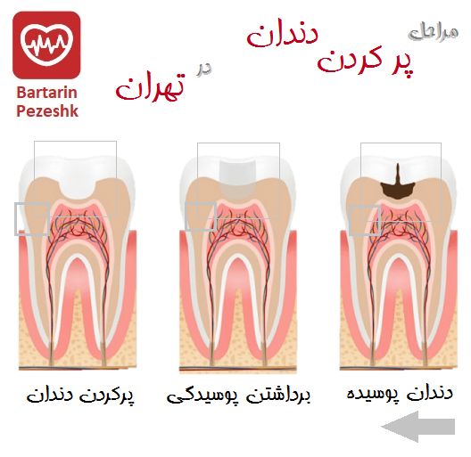 مراحل پر کردن دندان در تهران