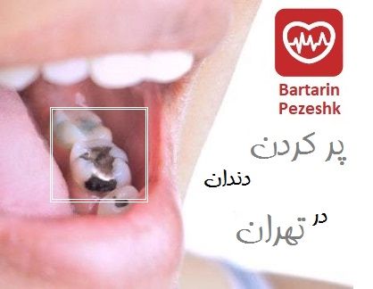پر کردن دندان در تهران