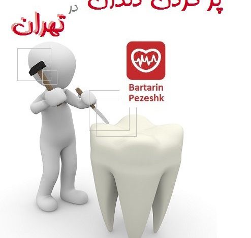پر کردن دندان در تهران
