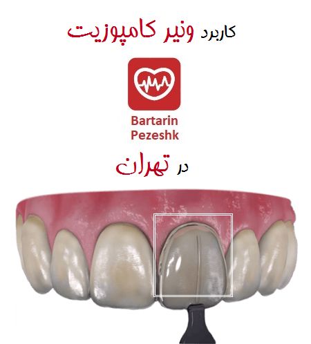 کاربرد ونیر کامپوزیت دندان در تهران