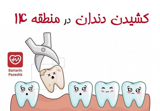 کشیدن دندان در منطقه 14