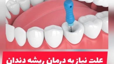 درمان ریشه دندان در شمال تهران