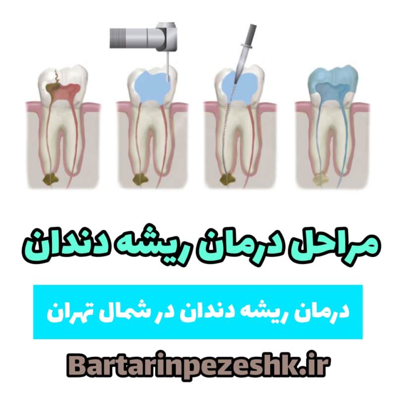 درمان ریشه دندان در شمال تهران