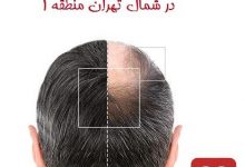 بهترین مراکز کاشت مو در شمال تهران منطقه 1