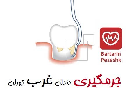 جرمگیری دندان غرب تهران
