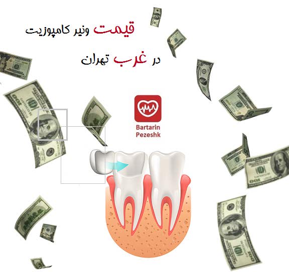 قیمت ونیر کامپوزیت دندان در غرب تهران