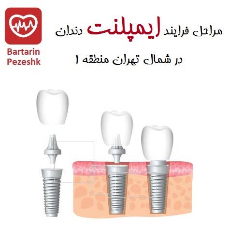 مراحل فرایند ایمپلنت دندان در شمال تهران منطقه 1