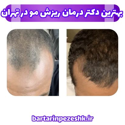 بهترین دکتر درمان ریزش مو در تهران
